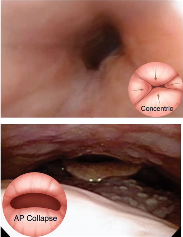 Orthodontics and Sleep Surgery