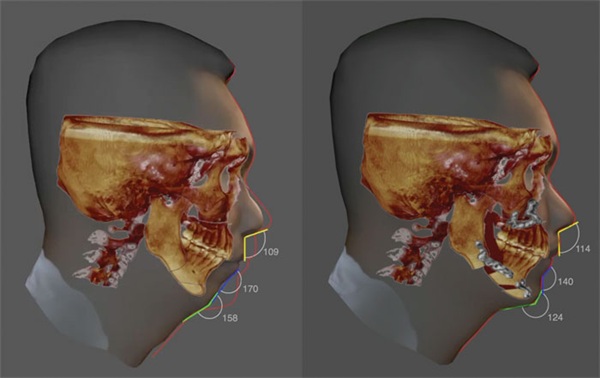 Orthodontics and Sleep Surgery