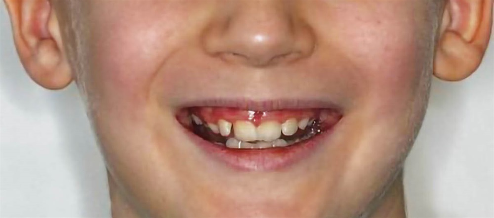 A Voice in the Arena: RPE, Caplin Hooks and Nighttime Elastics