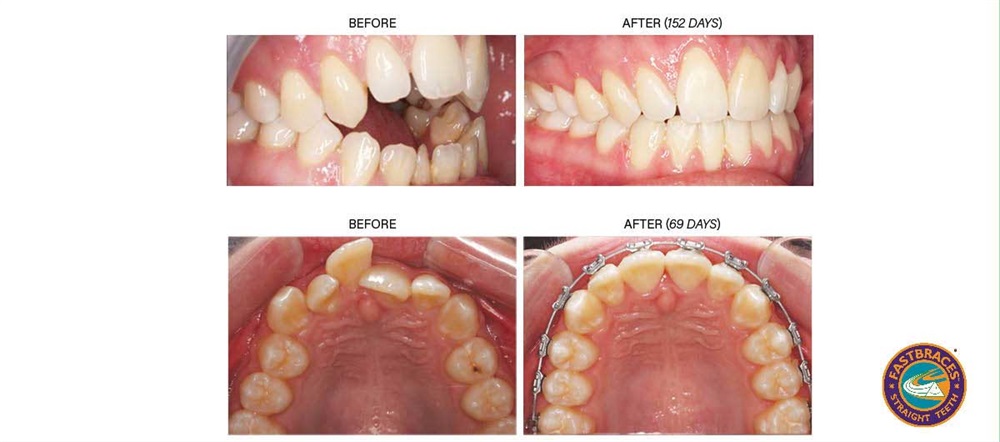 Product Profile: Fastbraces