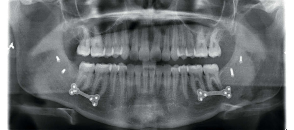 Surgical Orthodontic Treatment with Aligners