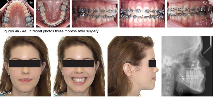 Columbia PA Orthodontist, Elastics For Braces