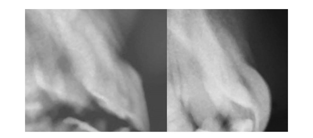 A Voice in the Area: Maxillary Central Incisor Labial Surface Shape