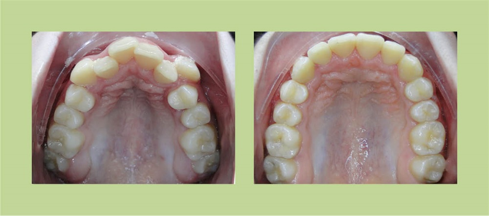 Townie Treatment Case: Non-Extraction Treatment Plan