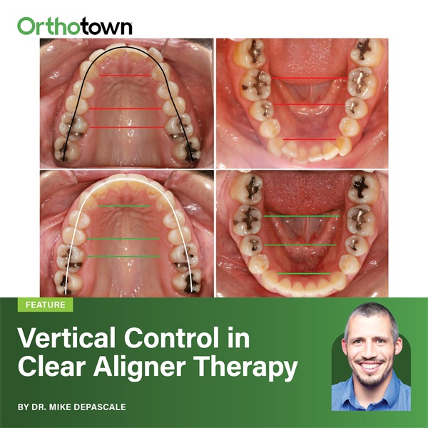 Vertical Control in Clear Aligner Therapy
