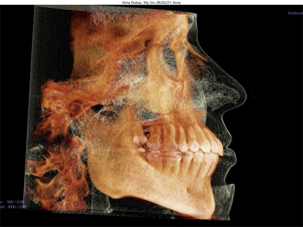Vertical Control in Clear Aligner Therapy
