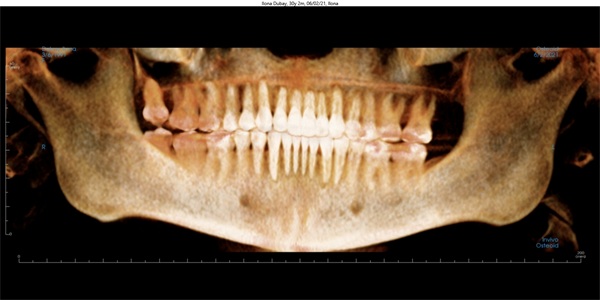 Vertical Control in Clear Aligner Therapy
