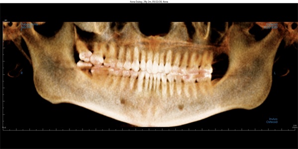 Vertical Control in Clear Aligner Therapy