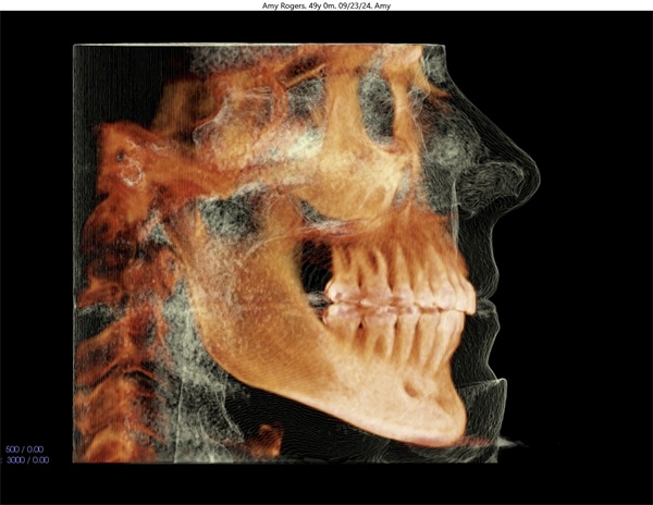 Vertical Control in Clear Aligner Therapy