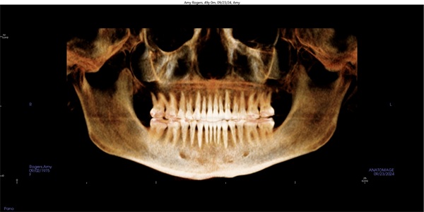 Vertical Control in Clear Aligner Therapy