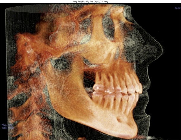 Vertical Control in Clear Aligner Therapy