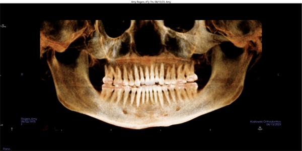 Vertical Control in Clear Aligner Therapy