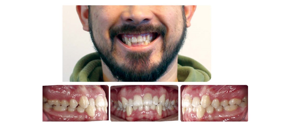 A Voice in the Arena: Early Cant Protocol: Asymmetric Bite Turbos and Elastics
