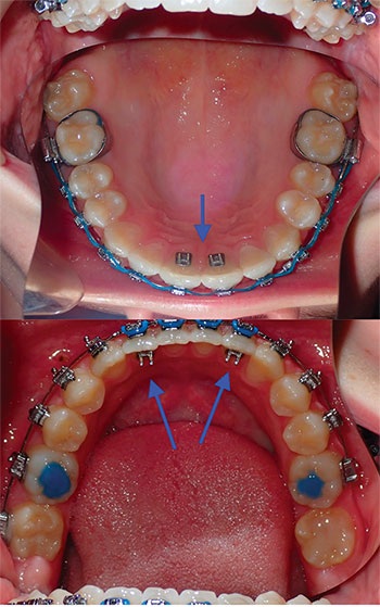Understanding Oral Facial Habits