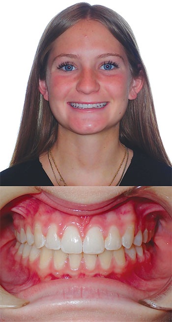 Understanding Oral Facial Habits