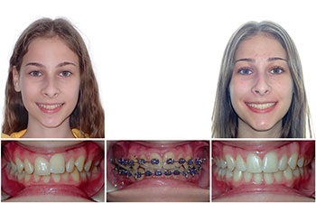 Understanding Oral Facial Habits