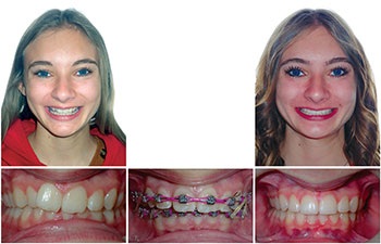 Understanding Oral Facial Habits