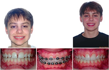 Understanding Oral Facial Habits