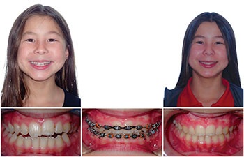 Understanding Oral Facial Habits