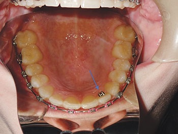 Understanding Oral Facial Habits