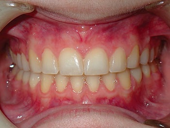 Understanding Oral Facial Habits