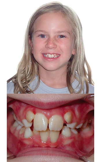Understanding Oral Facial Habits