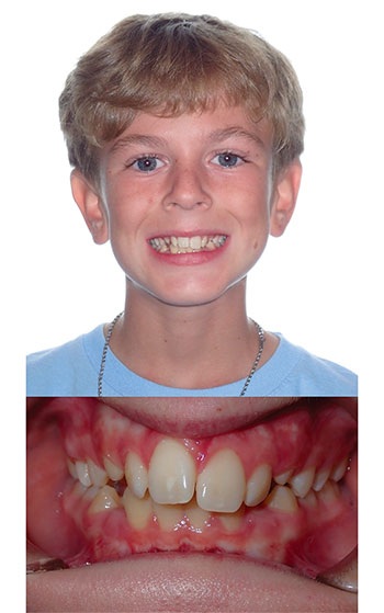 Understanding Oral Facial Habits