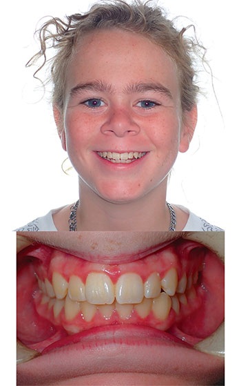 Understanding Oral Facial Habits