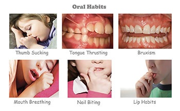 Understanding Oral Facial Habits