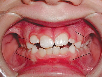 Understanding Oral Facial Habits