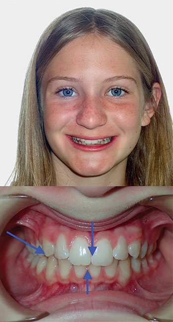 Understanding Oral Facial Habits