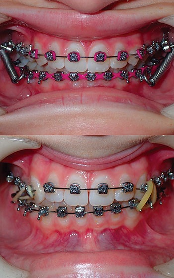 Understanding Oral Facial Habits