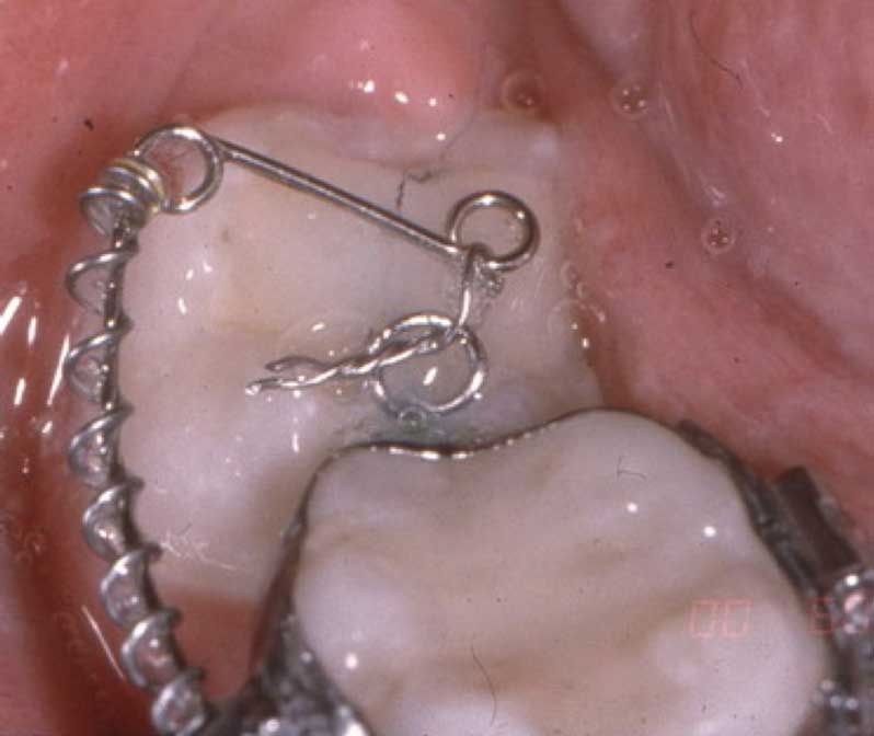 Freeing Impacted Lower Second Molar