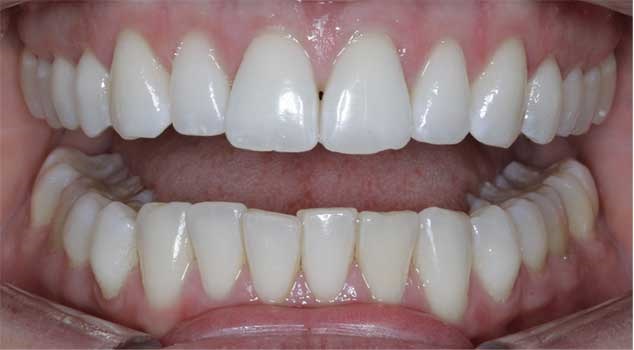 Hard tissue contouring