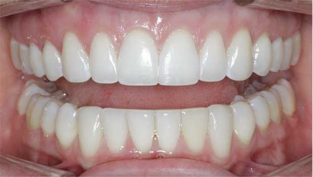 Hard tissue contouring
