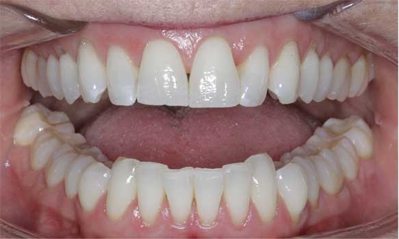 Hard tissue contouring