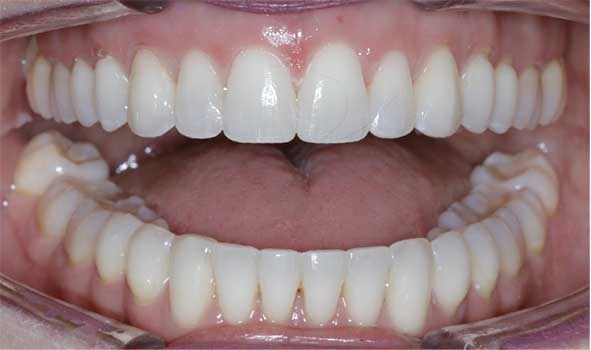 Hard tissue contouring