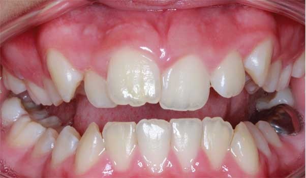 Hard tissue contouring