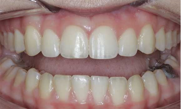Hard tissue contouring