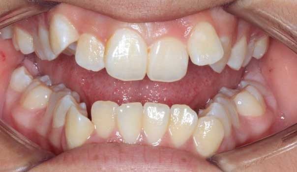 Hard tissue contouring