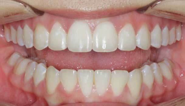 Hard tissue contouring