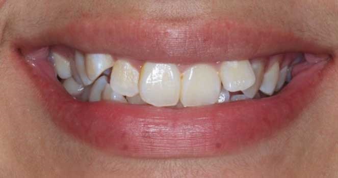 Hard tissue contouring