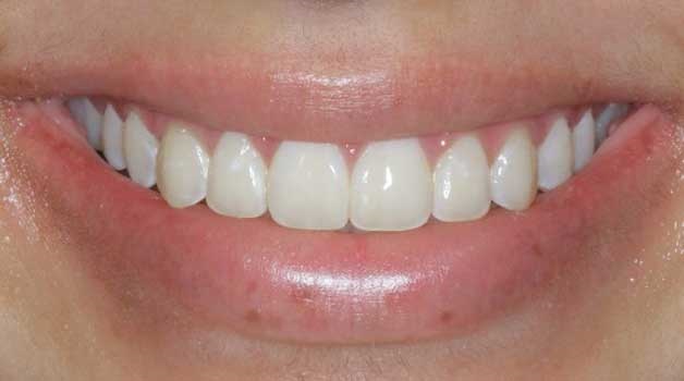 Hard tissue contouring