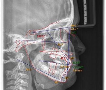 Microdontia with Delayed Development 