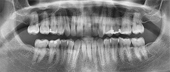 Fix Deep Bites Faster