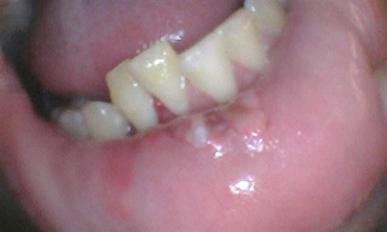 Straight Talk: Extrusion Trauma and a Root Fracture