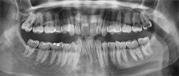 Fix Deep Bites Faster