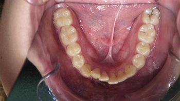 Straight Talk: Extrusion Trauma and a Root Fracture