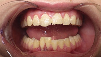 Straight Talk: Extrusion Trauma and a Root Fracture