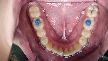 Straight Talk: Extrusion Trauma and a Root Fracture